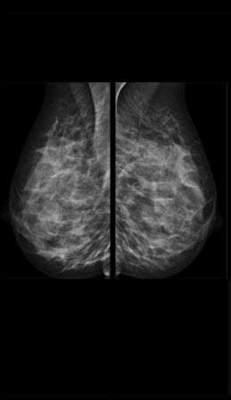 X-Ray