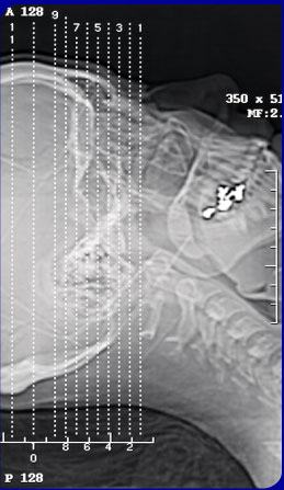 Ct+scan+abdomen+pelvis